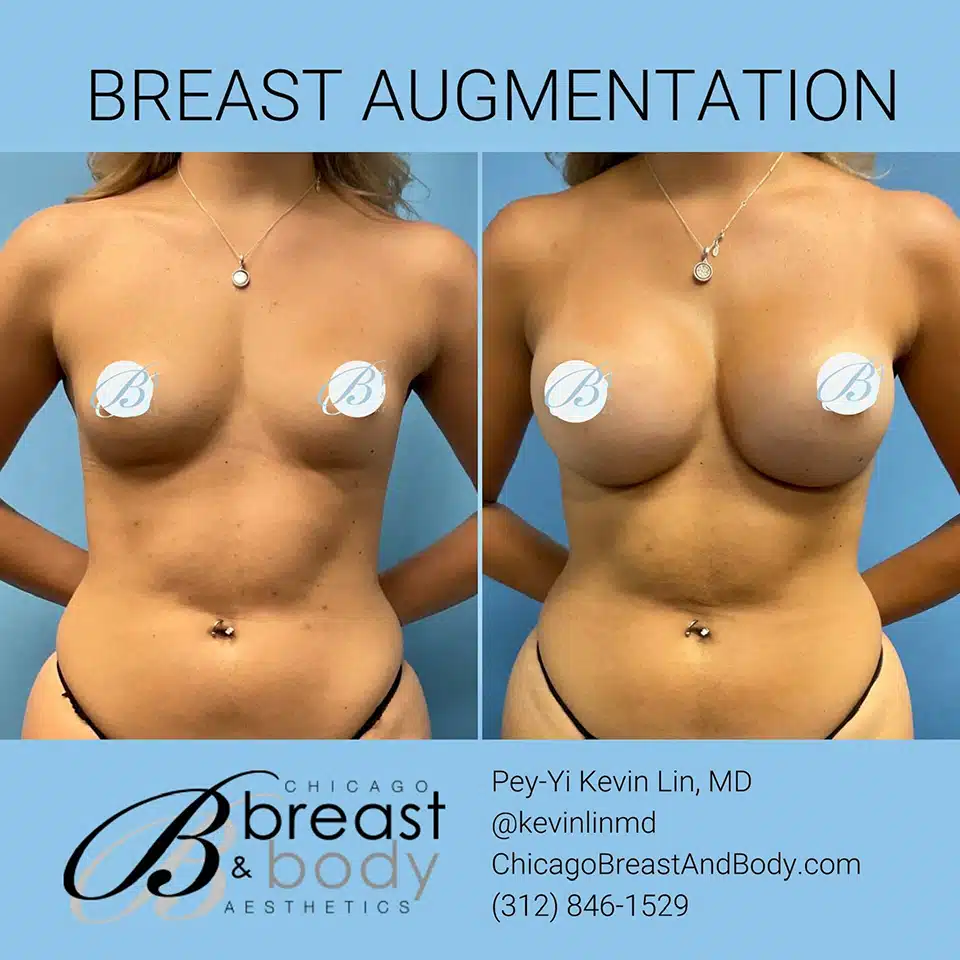 Breast-Augmentation-Chicago-copia copia
