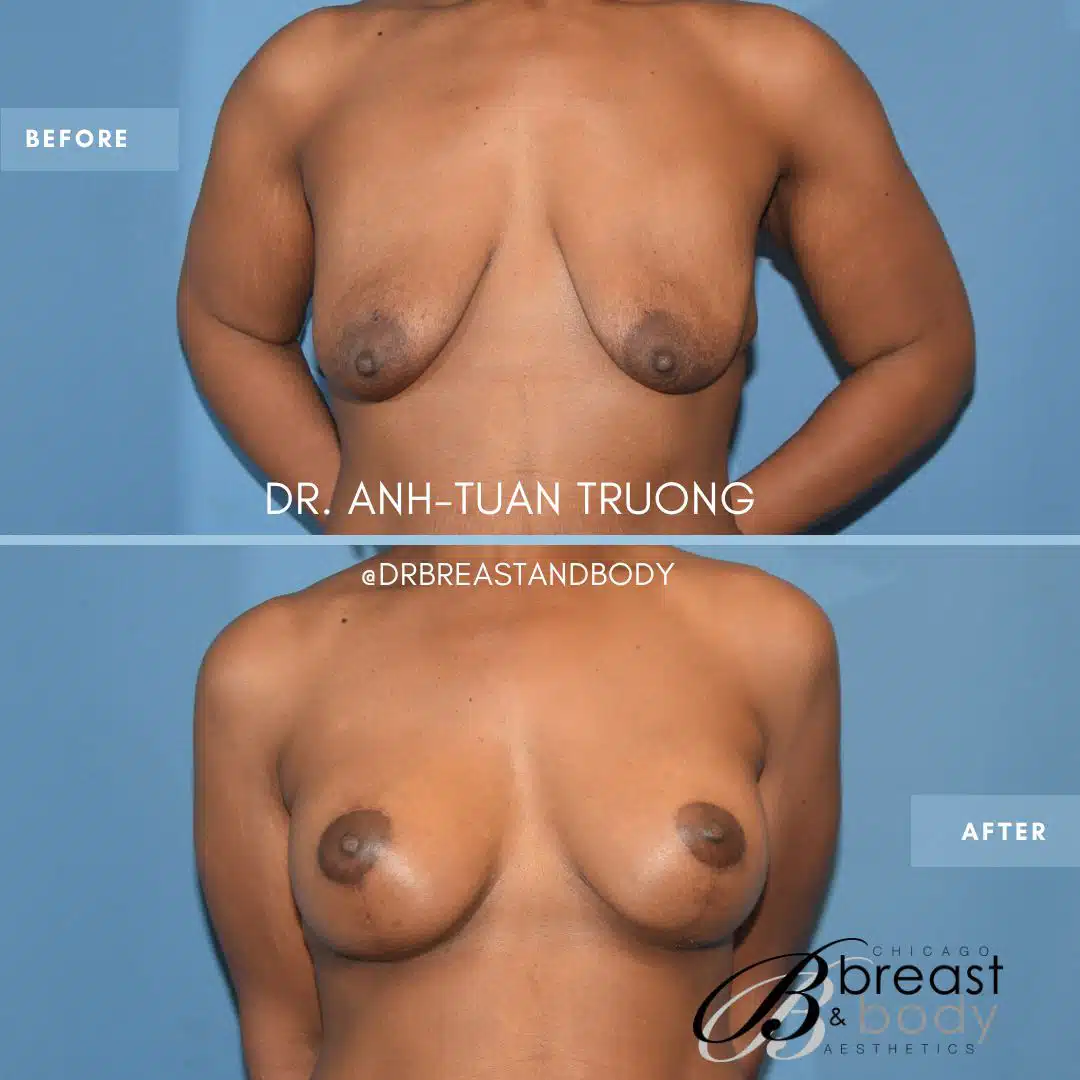 breast-lift-scars-chicago-truong copia