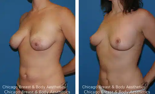 breast-lift-surgery-scars-photo copia