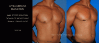 GYNECOMASTIA10
