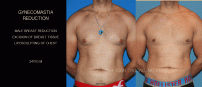 GYNECOMASTIA11