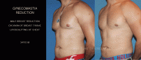 GYNECOMASTIA