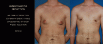 GYNECOMASTIA7