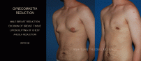 GYNECOMASTIA8