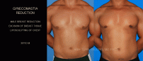 GYNECOMASTIA9