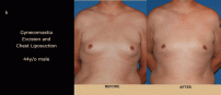 Gynecomastia3