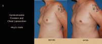 Gynecomastia4