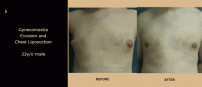 Gynecomastia5