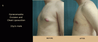 Gynecomastia6