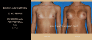 meet-dr-truong-1 - Breast Augmentation Surgeon