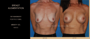 Breast implant placement - Breast Implant Incision