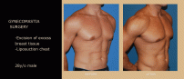 Gynecomastia2