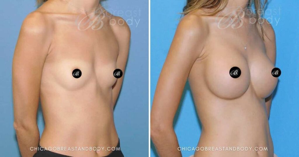 before after breast implants chicago breast and body