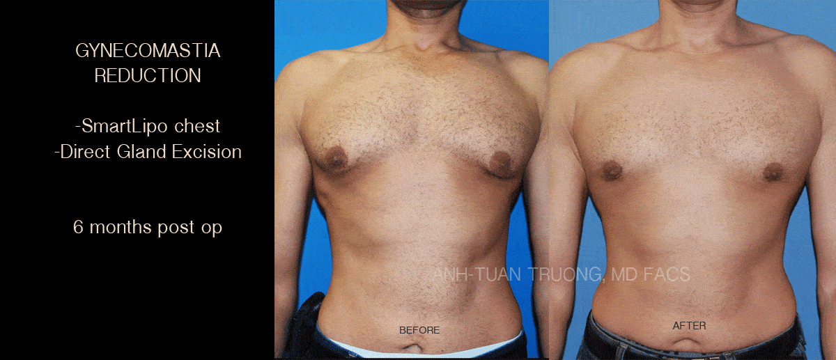 What is Gynecomastia Chicago Breast and Body Aesthetics