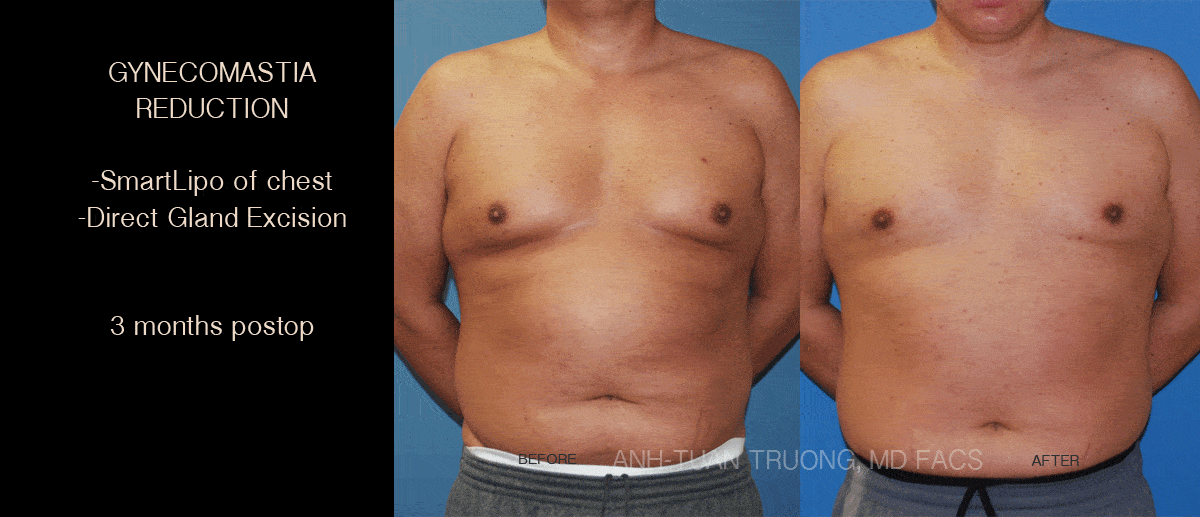 gynecomastia before and after photo chicago breast and body aesthetics