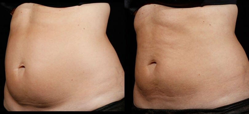 SculpSure-Female-Before-After