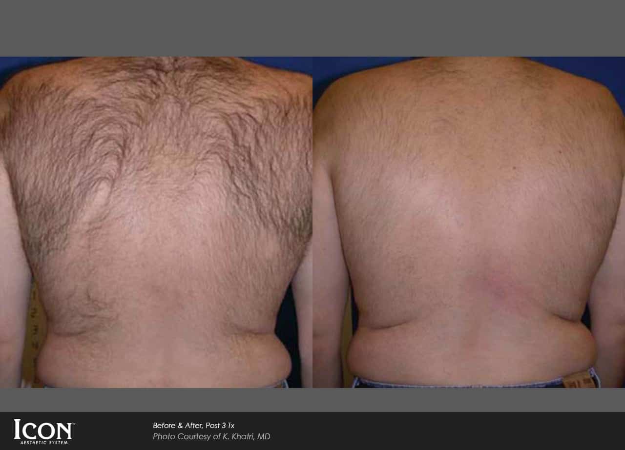 best-laser-hair-removal-in-chicago