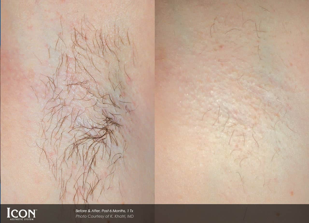 chicago-laser-hair-removal