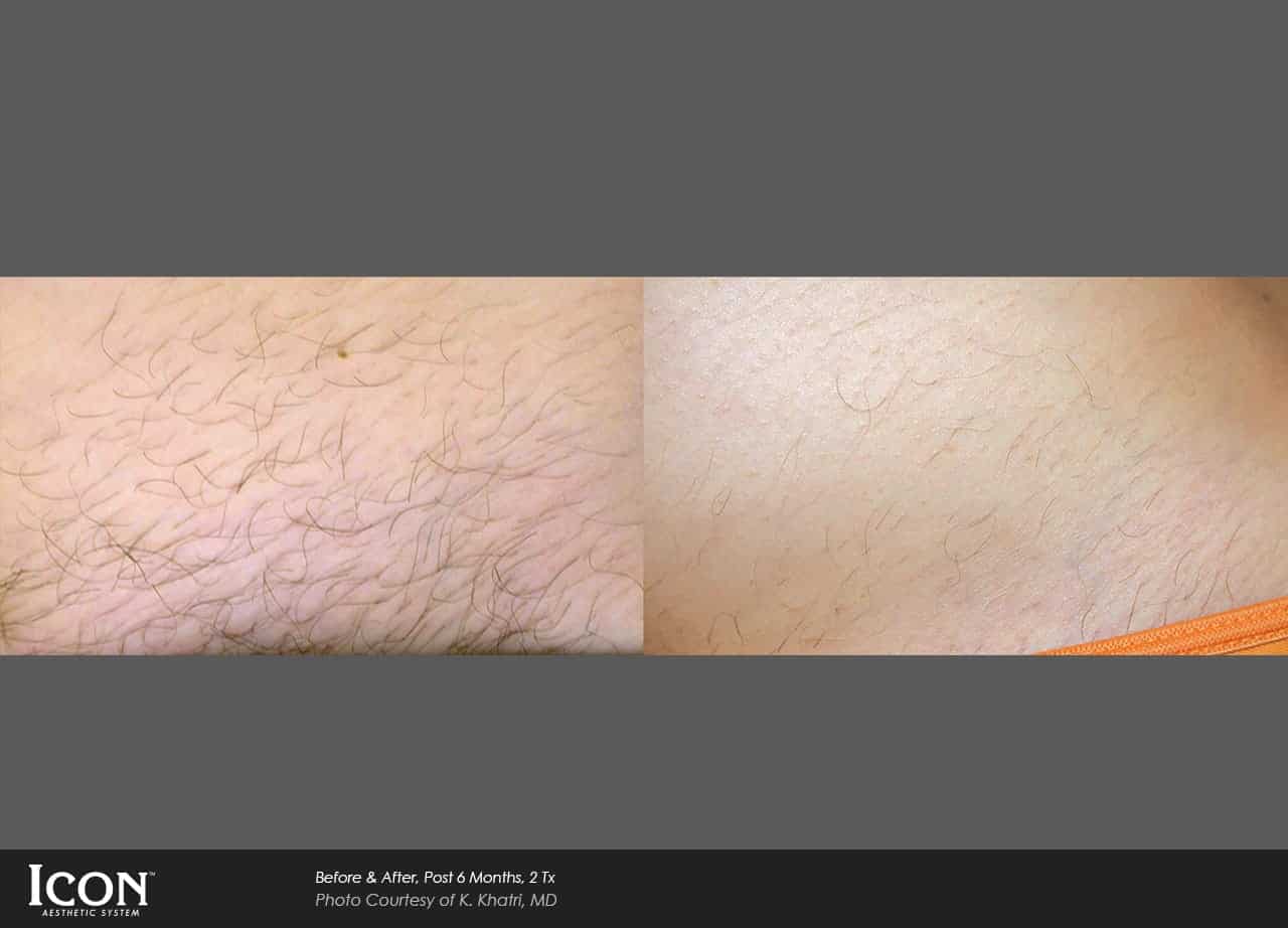 laser-hair-removal-chicago