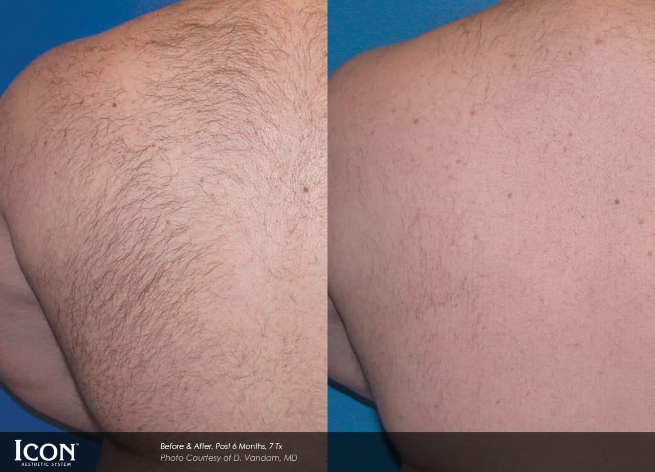laser-hair-removal-in-chicago-il