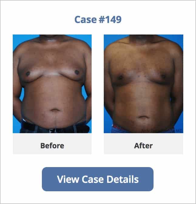 Chicago Male Breast Reduction