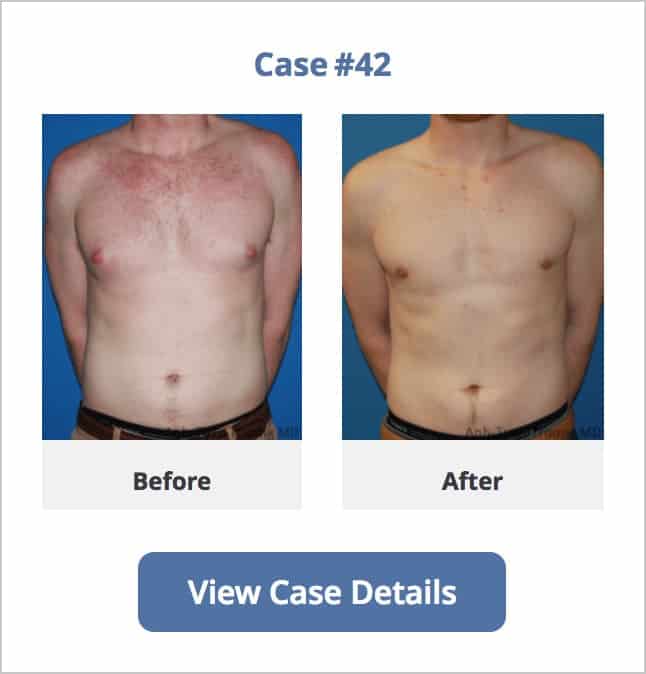 Gynecomastia surgery before and after gallery