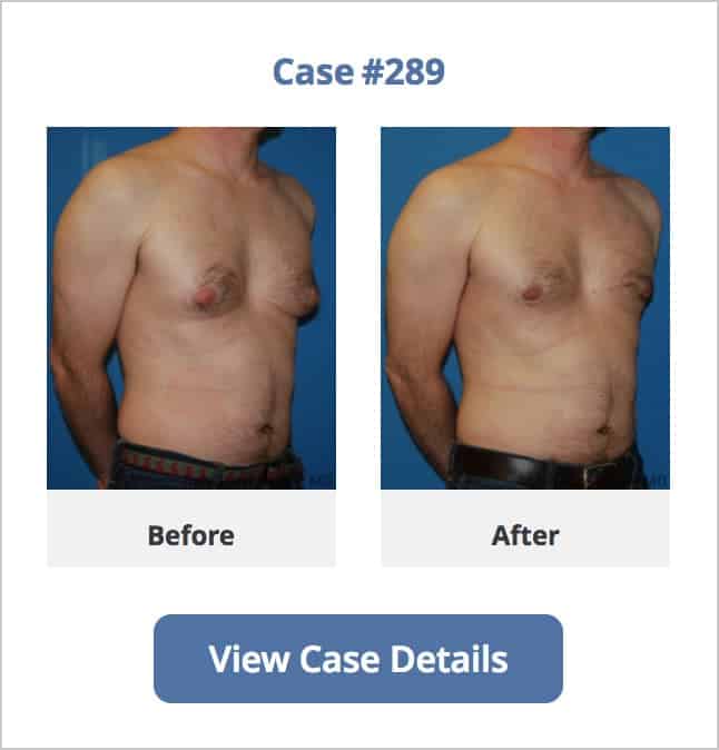 Male breast Reduction Chicago
