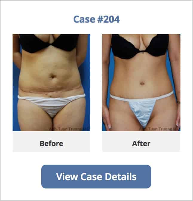Mini Tummy Tuck Before After 1