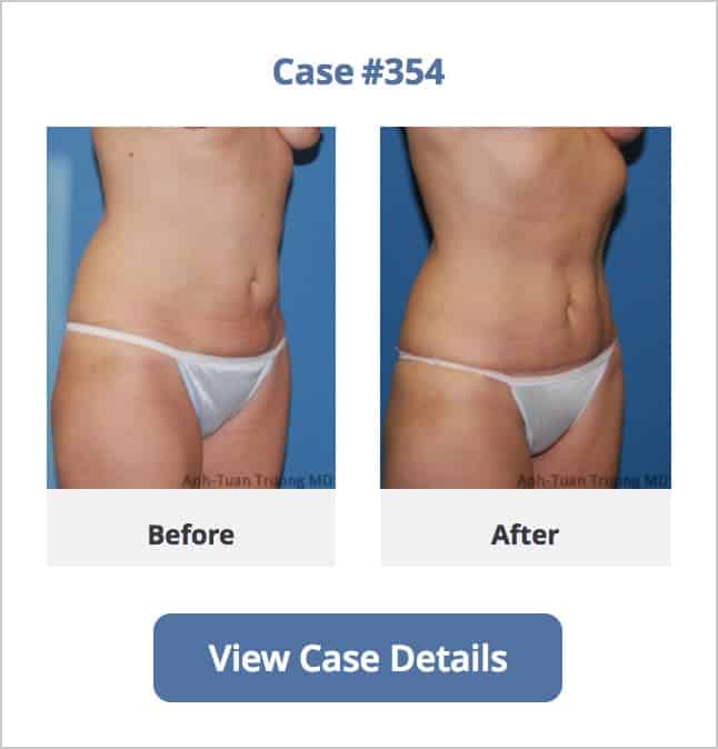 A before and after mini tummy tuck surgery by Chicago Breast and Body Aesthetics