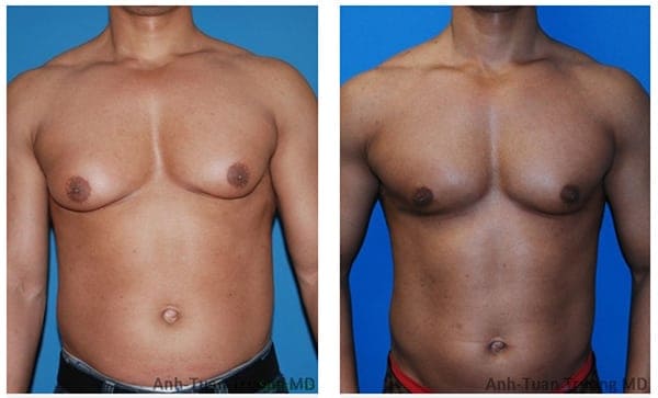 gynecomastia-before-and-after