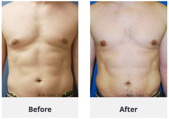 male-breast-reduction-chicago