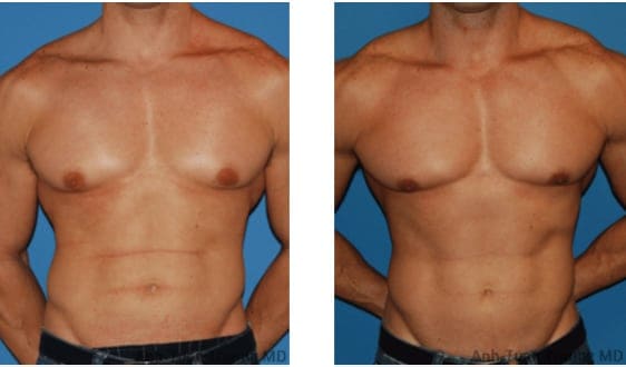 male-breast-reduction-in-chicago