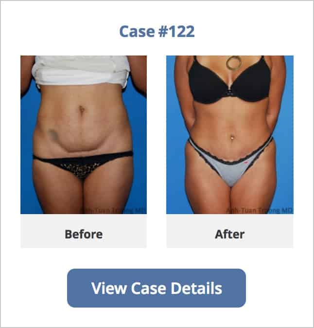 Going For Tummy Tuck Surgery, Consider These Smart Recovery Tips