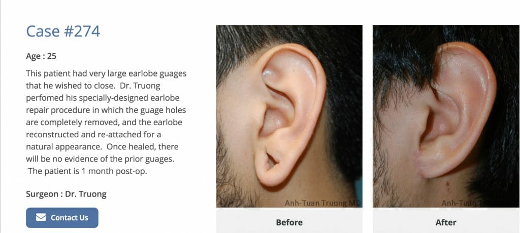 earlobe repair surgery Chicago breast and body aesthetics