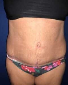 plus size tummy tuck before after by Dr. Francine Vagotis Chicago Breast & Body Aesthetics