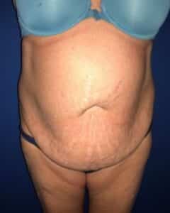plus size tummy tuck before after by francine vagotis2