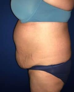 plus size tummy tuck before after by francine vagotis3