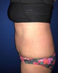 plus size tummy tuck before after by francine vagotis4