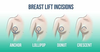 How is a breast lift done