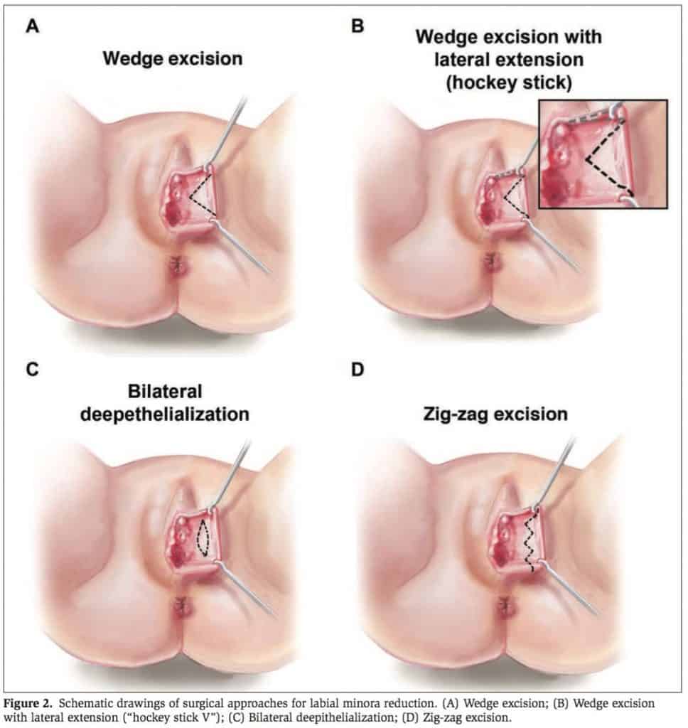 Cosmetic Vaginal Surgery Atlanta, Labiaplasty