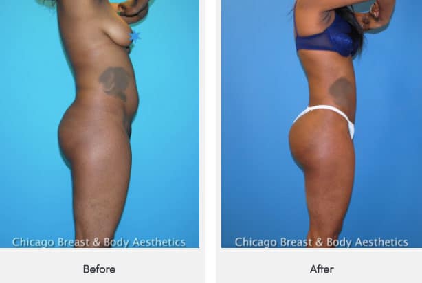 brazilian butt lift surgery cost