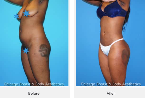 Brazilian Butt Lift Or BBL Surgery Cost In Chicago
