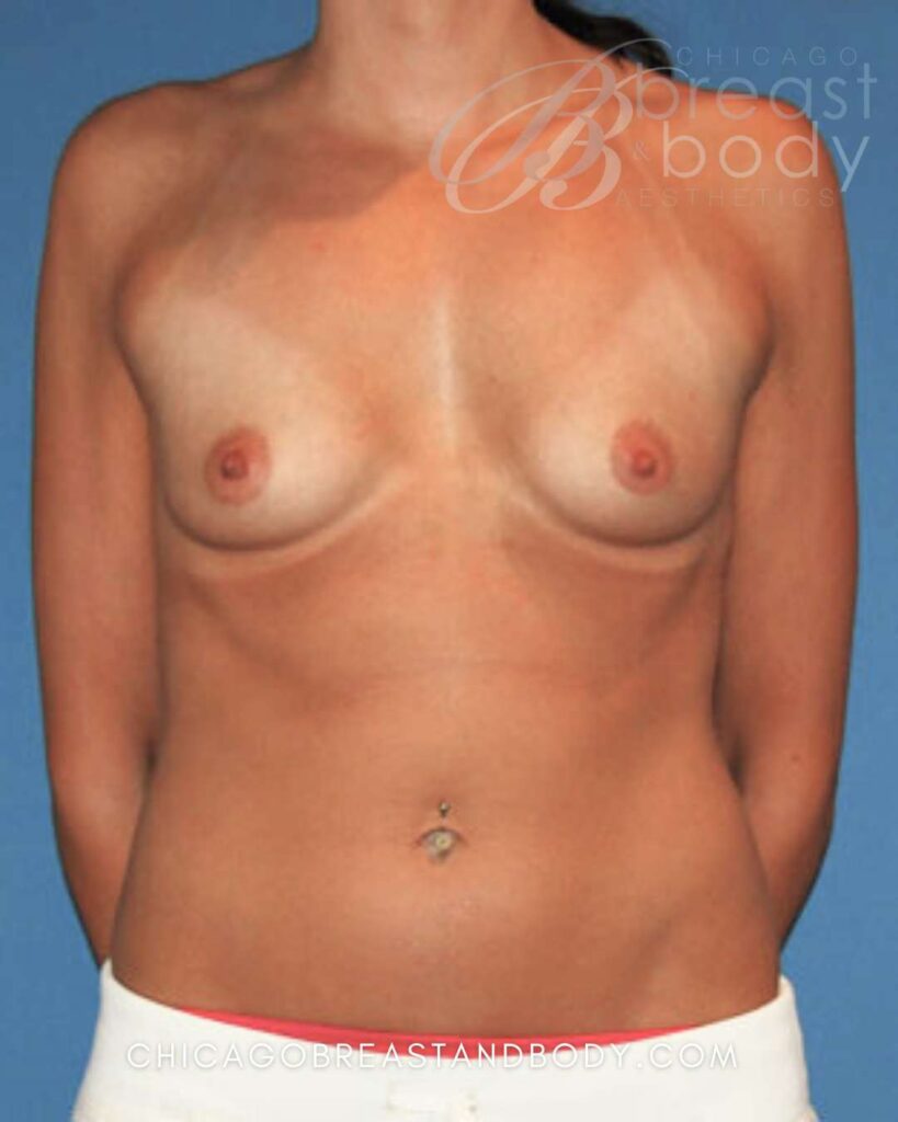 Breast Augmentation Before After 400ccs 103 by Dr. Anh Tuan Truong Chicago Breast and Body