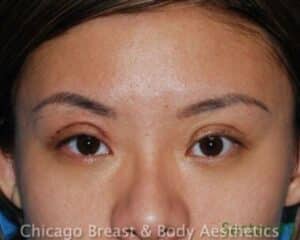Case 1: Asian eyelid surgery before and after by Chicago Breast and Body Aesthetics