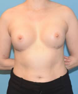 Before after breast augmentation by Dr. Francine Vagotis case 15