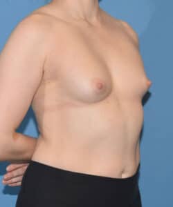 Before after breast augmentation by Dr. Francine Vagotis case 15