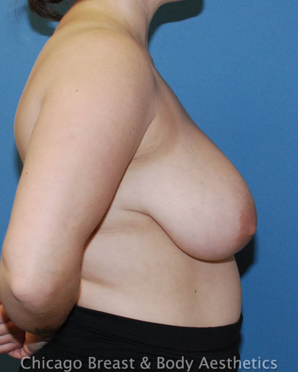Breast Lift (Mastopexy), Breast Reduction (Mammaplasty) before photo 3, case #6530, Dr. Anh-Tuan Truong, Chicago Breast & Body