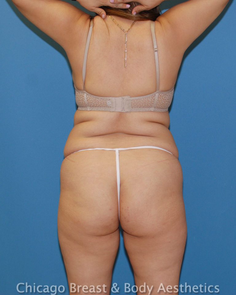 Before Lipo 360, back view, case 485, patient of Dr. Anh-Tuan Truong