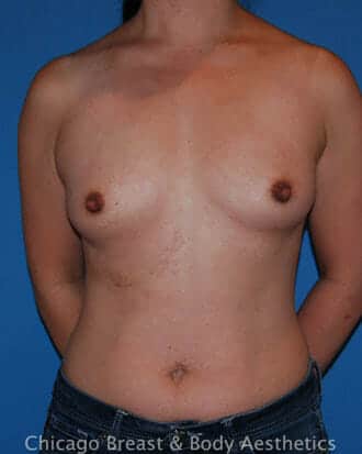Chicago Breast and Body plus