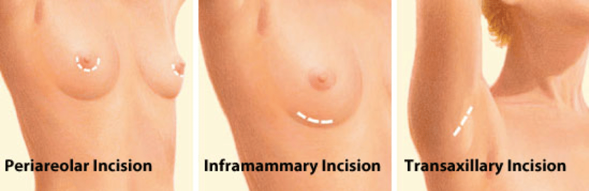 3 types of breast implant incisions